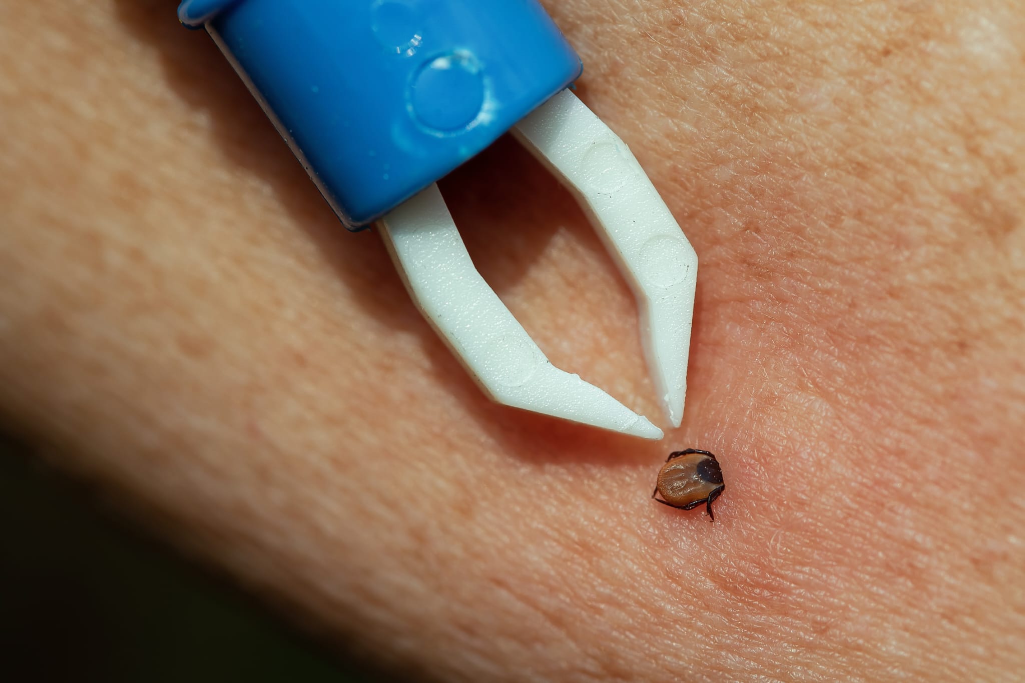 Procedura wyjmowania kleszcza